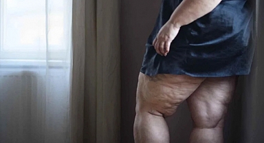 Kadınların Gizli Düşmanı: Lipödem!